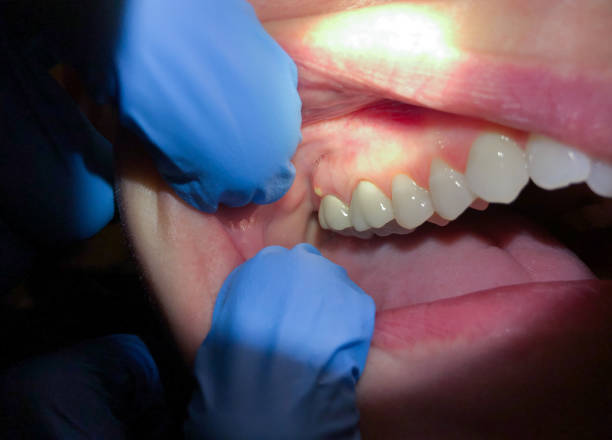 Best Chipped Tooth Repair Near Me  in Woodbury Center, CT